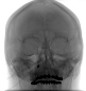 Angiographie (3D)